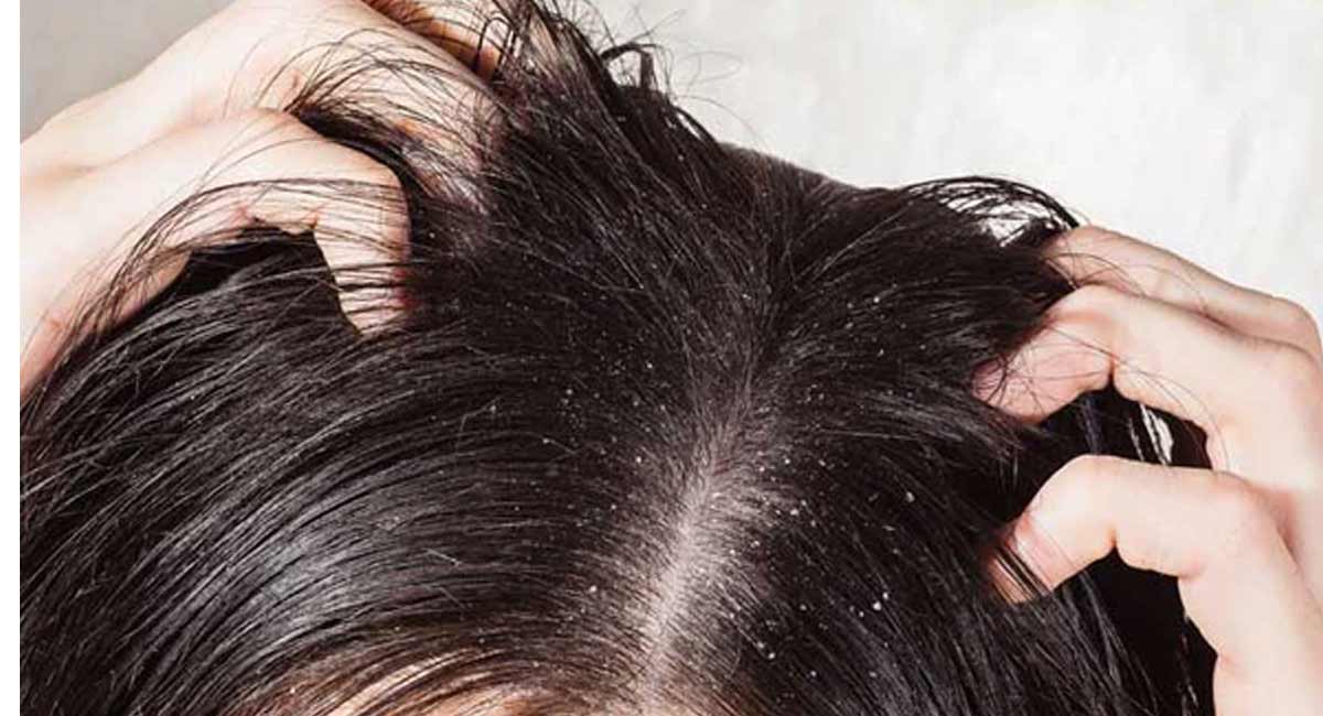 People suffering from dandruff problem should know these things