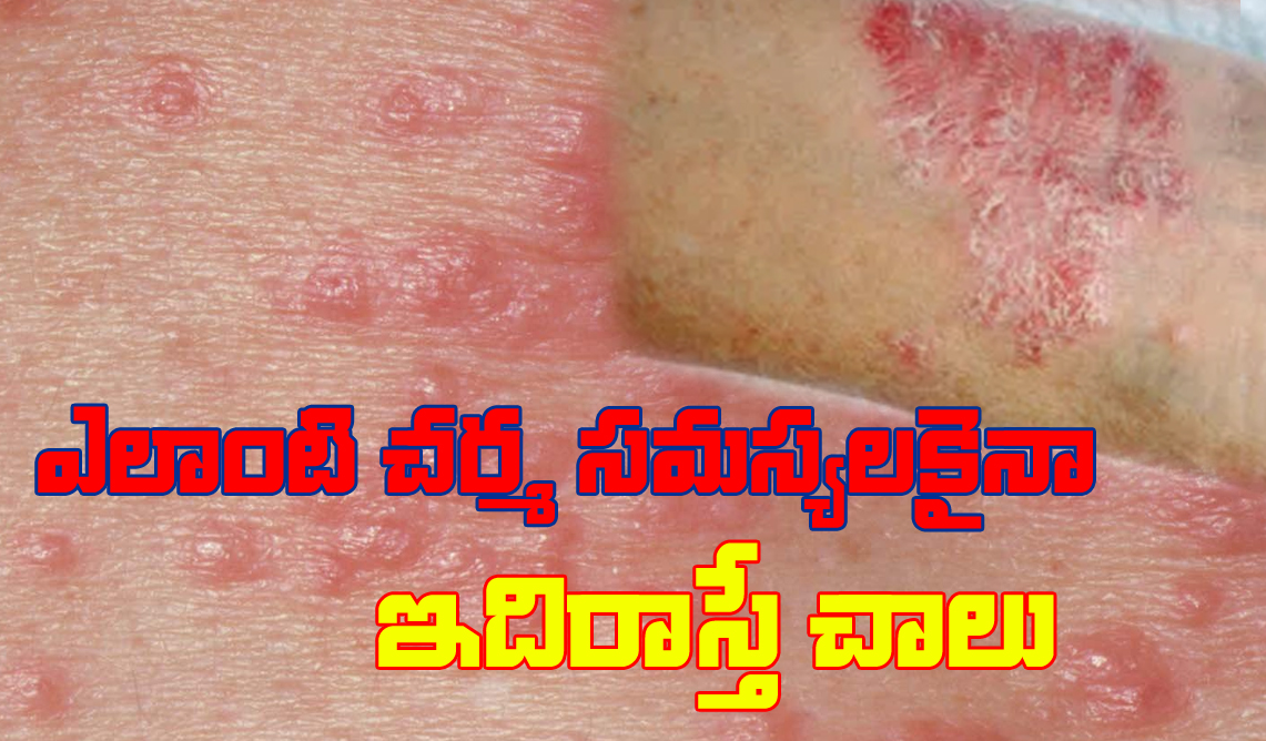 Scabies Itchy Eczema Psoriasis Any skin disease will disappear in three days
